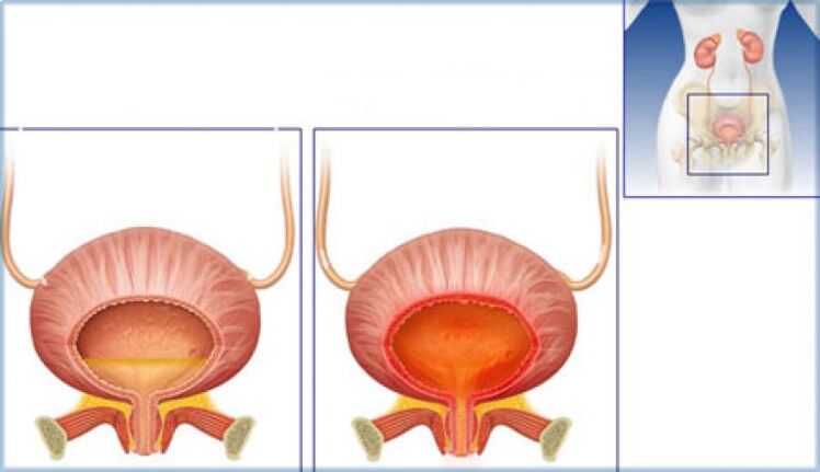 Bladder is normal with signs of inflammation due to cystitis