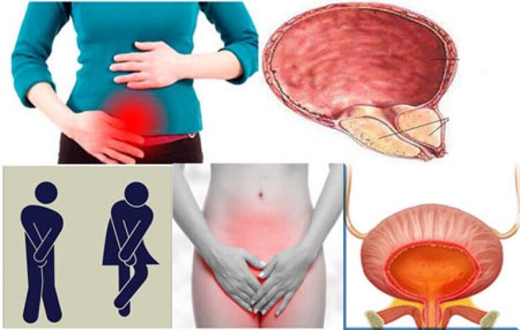 Signs of cystitis in women - burning sensation and pain when urinating